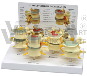 4-Stage Vertebrae